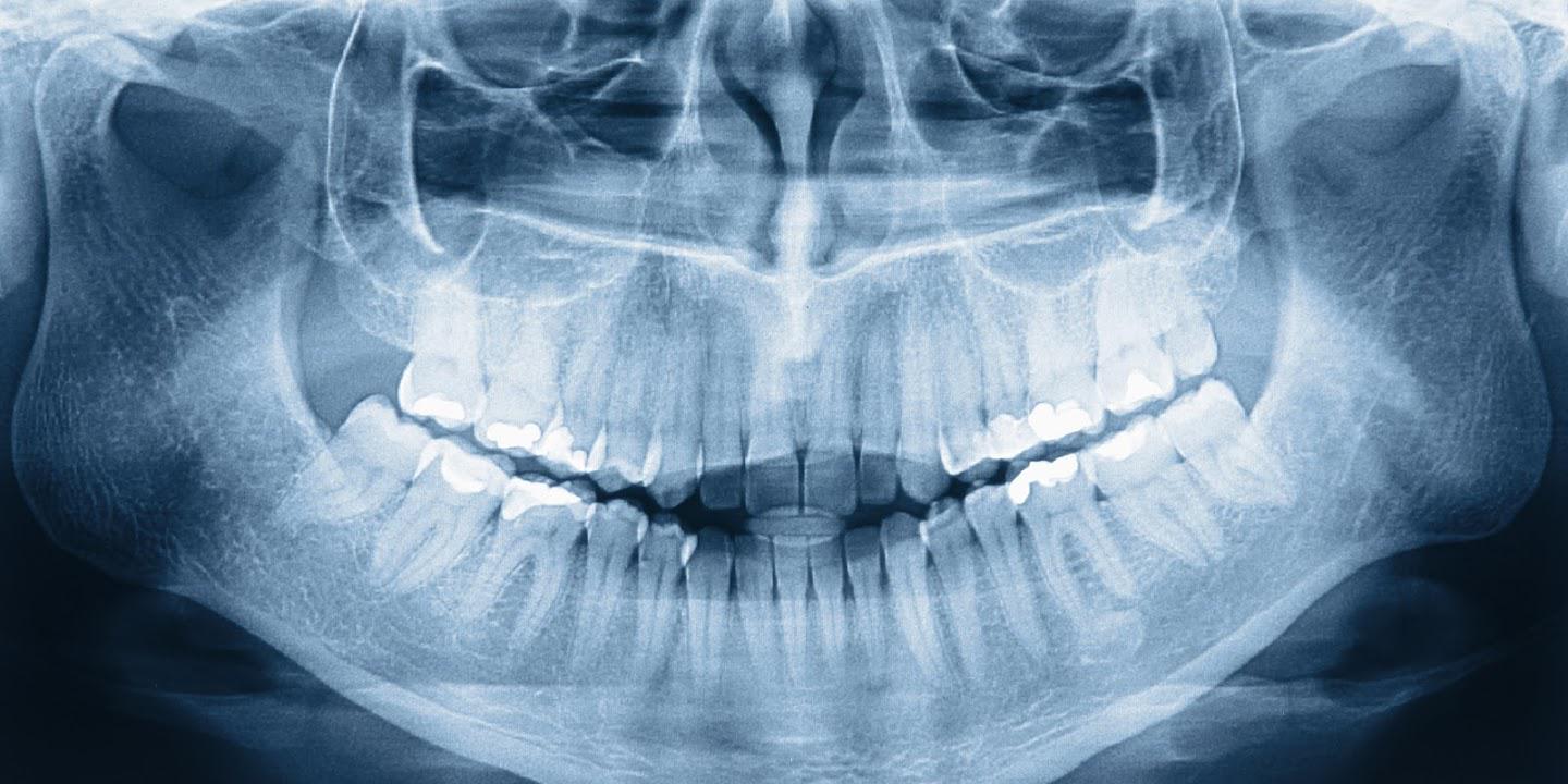 Tooth Fracture Xray